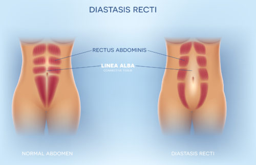Diastasis Recti (Abdominal Separation) - Elevate Physical Therapy